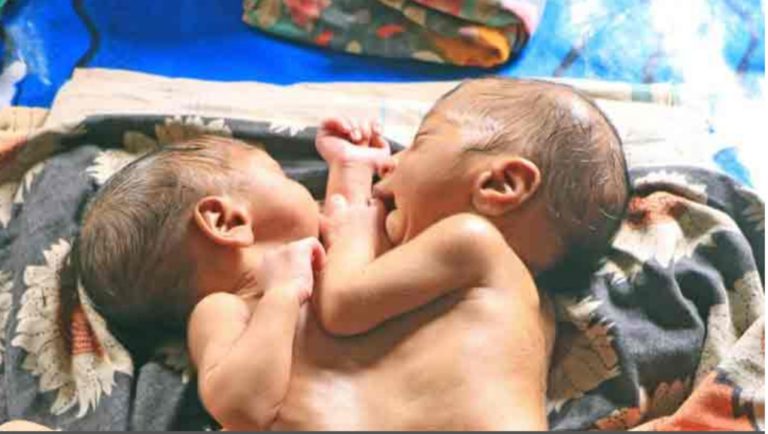 জোড়া লাগানো যমজ শিশুর জন্ম, সু-চিকৎসার জন্য দুশ্চিন্তায় পরিবার