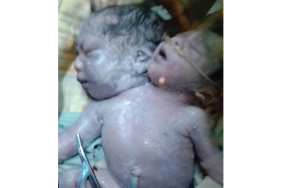 নীলফামারীতে দুই মাথা নিয়ে নবজাতকের জন্ম