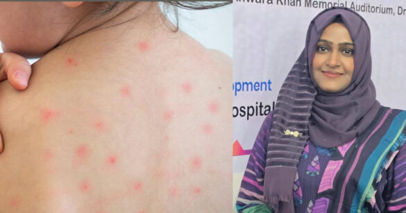 হাম একটি ভাইরাসজনিত ছোঁয়াচে রোগ। সঠিক সময়ে সঠিক যত্ন না নিলে এটি শিশুর জন্য নিউমোনিয়া বা ডায়রিয়ার মতো গুরুতর জটিলতা তৈরি করতে পারে। তবে আতঙ্কিত না হয়ে চিকিৎসকদের পরামর্শ অনুযায়ী ঘরেই শিশুর উপযুক্ত পরিচর্যা করা সম্ভব।