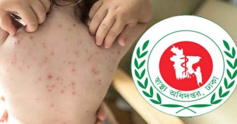 হাম ও উপসর্গ নিয়ে ২৪ ঘণ্টায় আরও ৩ শিশুর মৃত্যু