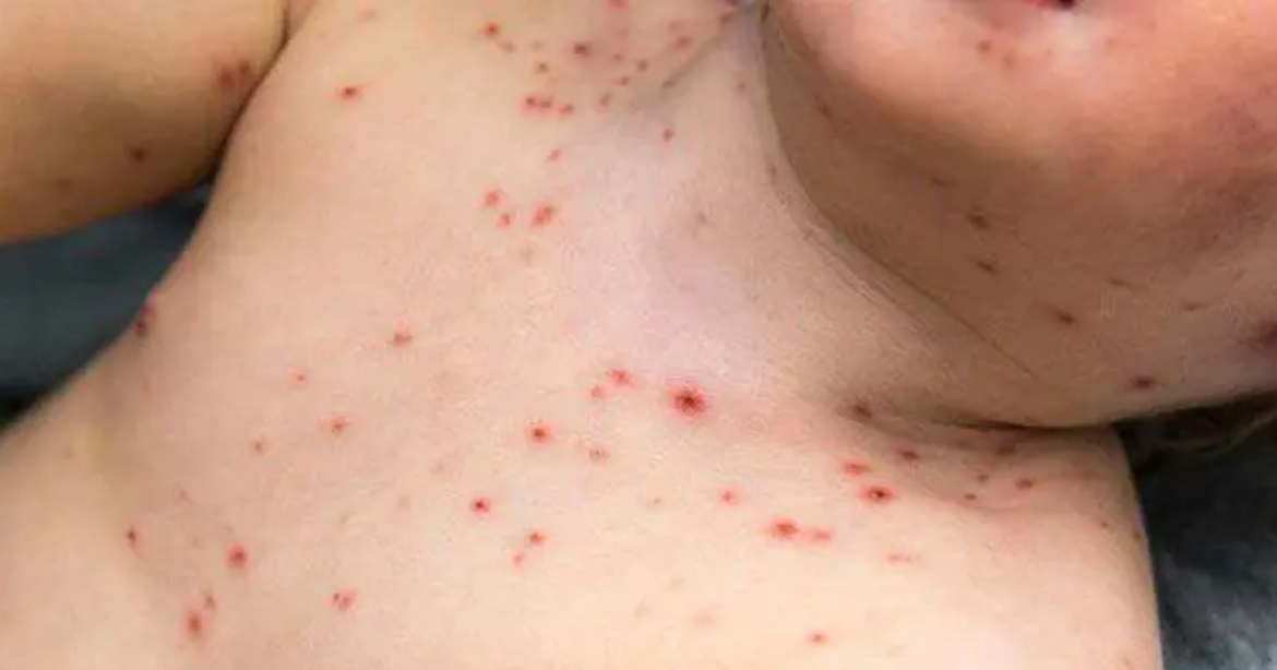 দেশে ভয়াবহ রূপ নিচ্ছে হাম।