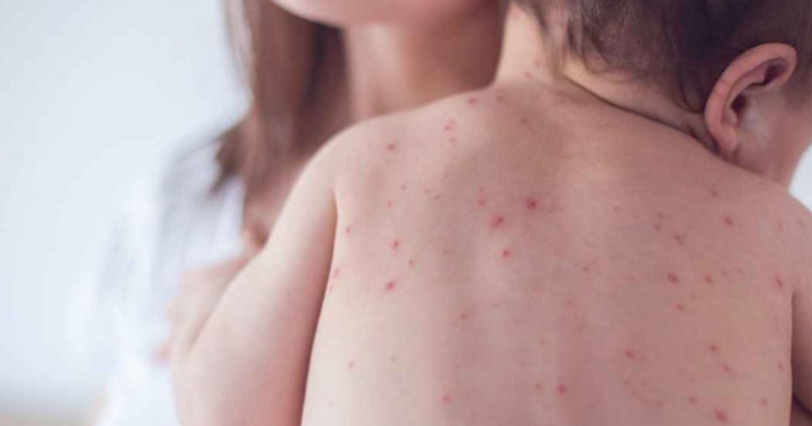 গত ২২ দিনে সারাদেশে হাম সন্দেহে মৃত্যু হয়েছে ১১৩ জনের আর আক্রান্ত হয়েছে ৭৬১০ জন শিশু।