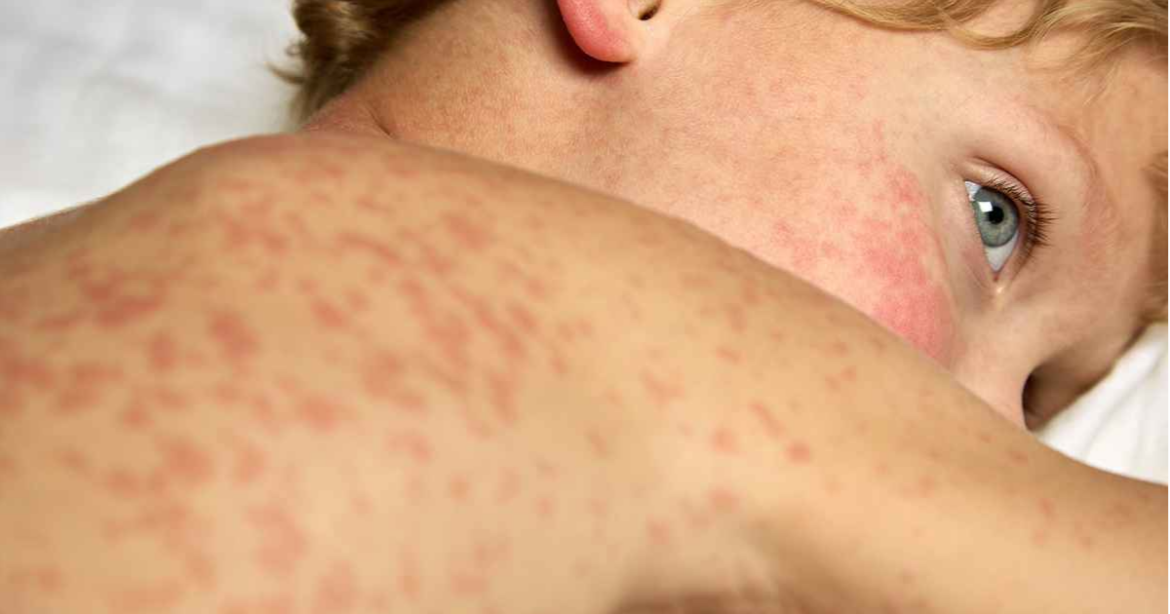 দেশে ভয়াবহ রূপ নিচ্ছে হাম।