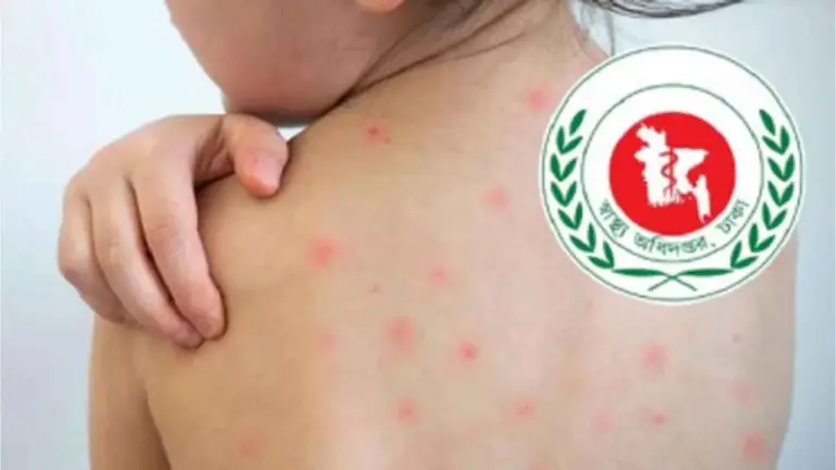 হামের উপসর্গে আরও ৯ প্রাণহানি, আক্রান্ত ১,৩৪১